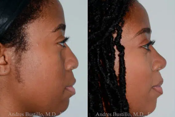 Rhinoplasty Before and After Photos in Miami, FL, Patient 17855