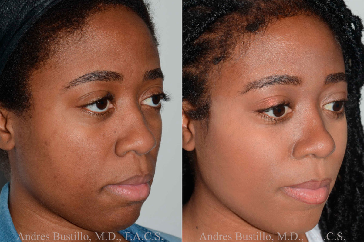 Rhinoplasty Before and After Photos in Miami, FL, Patient 17855