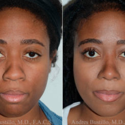 Rhinoplasty Before and After Photos in Miami, FL, Patient 17855