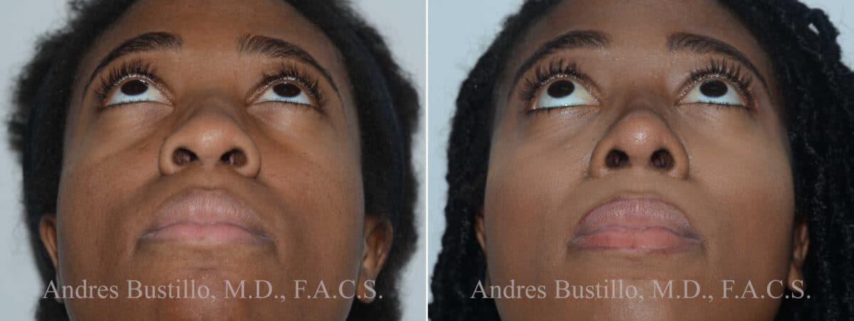 Rhinoplasty Before and After Photos in Miami, FL, Patient 17855