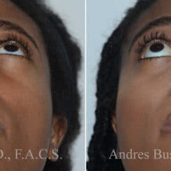 Rhinoplasty Before and After Photos in Miami, FL, Patient 17855