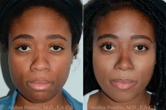 Rhinoplasty Before and After Photos in Miami, FL, Patient 17855