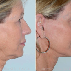 Deep Plane Facelift Before and After Photos in Miami, FL, Patient 17882