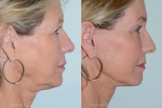 Deep Plane Facelift Before and After Photos in Miami, FL, Patient 17882