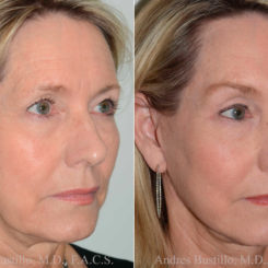 Deep Plane Facelift Before and After Photos in Miami, FL, Patient 17882