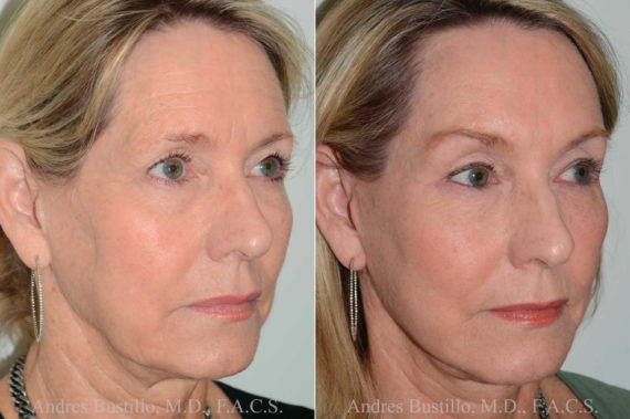 Deep Plane Facelift Before and After Photos in Miami, FL, Patient 17882