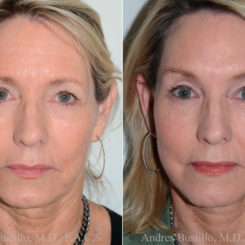 Deep Plane Facelift Before and After Photos in Miami, FL, Patient 17882