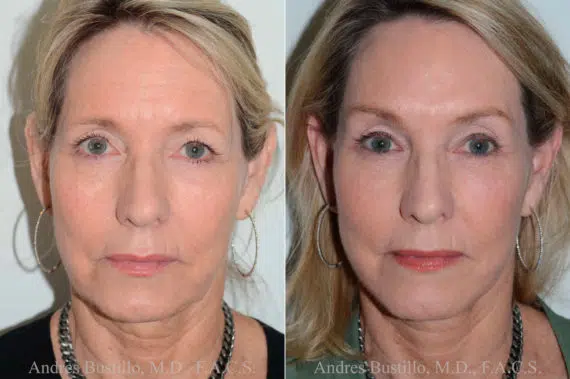 Deep Plane Facelift Before and After Photos in Miami, FL, Patient 17882