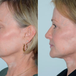 Deep Plane Facelift Before and After Photos in Miami, FL, Patient 19444