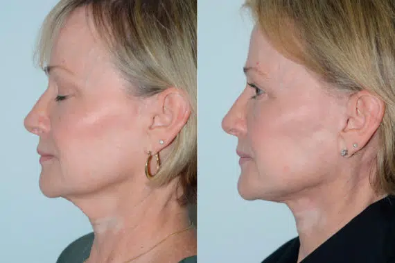 Deep Plane Facelift Before and After Photos in Miami, FL, Patient 19444