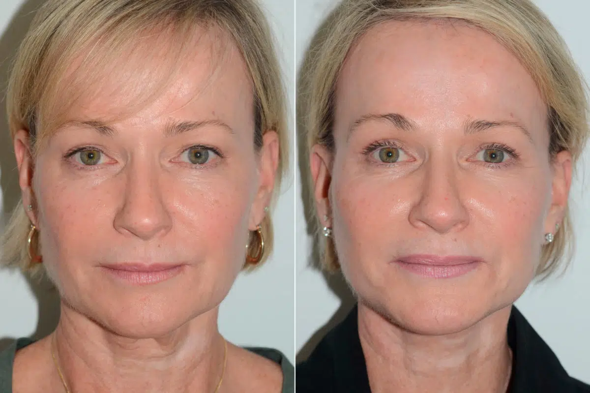 Deep Plane Facelift Before and After Photos in Miami, FL, Patient 19444