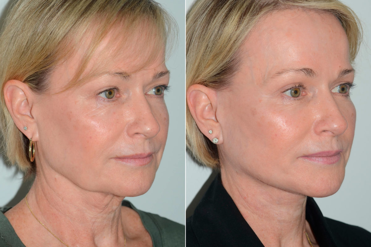 Deep Plane Facelift Before and After Photos in Miami, FL, Patient 19444