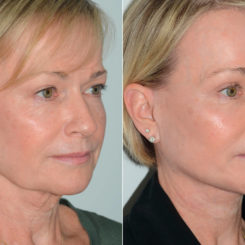 Deep Plane Facelift Before and After Photos in Miami, FL, Patient 19444