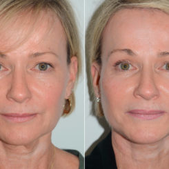 Deep Plane Facelift Before and After Photos in Miami, FL, Patient 19444