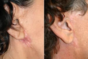 Scars after Facelift Surgery