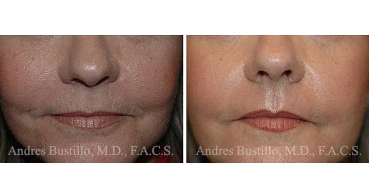 Dermabrasion Miami Reveal Youthful Skin with Dr. Bustillo