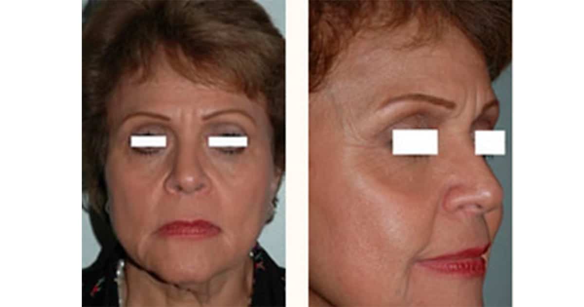 Facial Fat Transfer Miami Restore Facial Volume with Dr. Bustillo