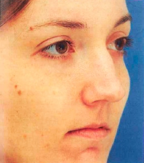 A photo of a female rhinoplasty patient