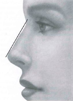 Diagram of a Female Nose for Rhinoplasty