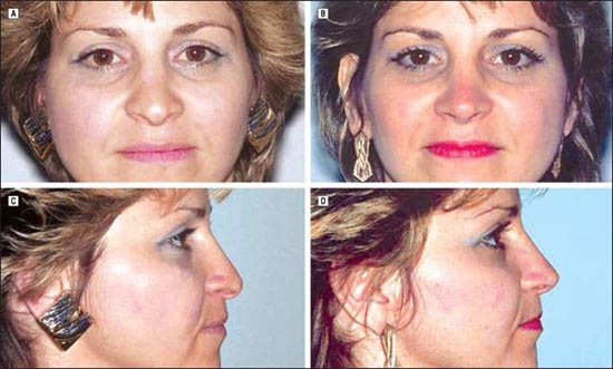 Pre & Post-op Rhinoplasty - Extended Columellar Strut-Tip Graft