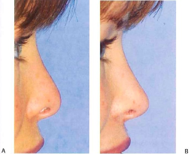 Preoperative close-up of Augmentation Rhinoplasty