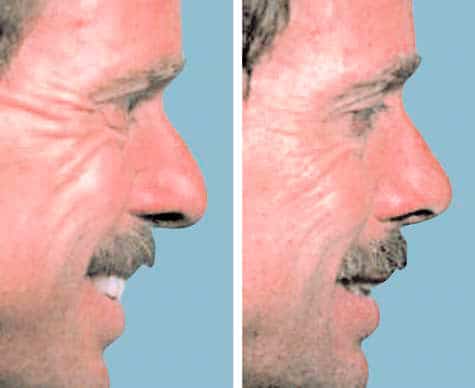 Lateral views of the patient with caudal septal deviation