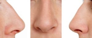 Natural Grafts and Synthetic Implants in Rhinoplasty