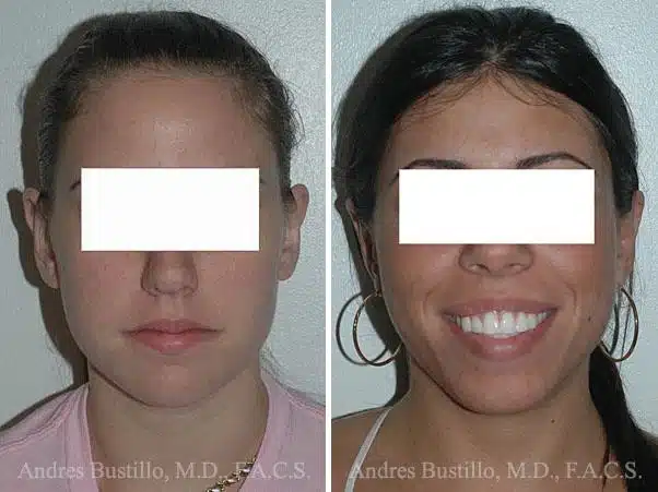 Otoplasty Photos