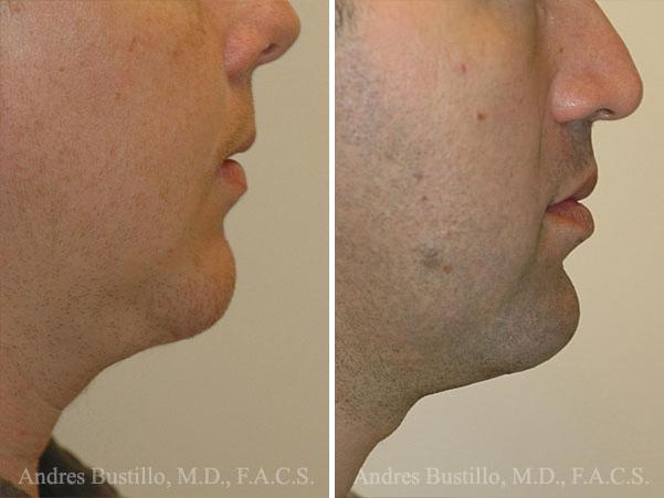 Chin Augmentation Photos