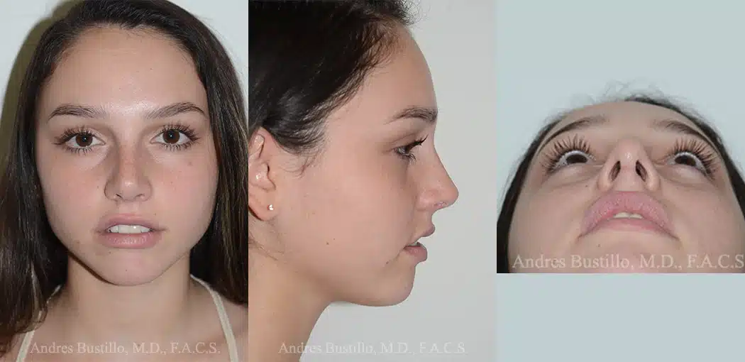 Rhinoplasty Photos