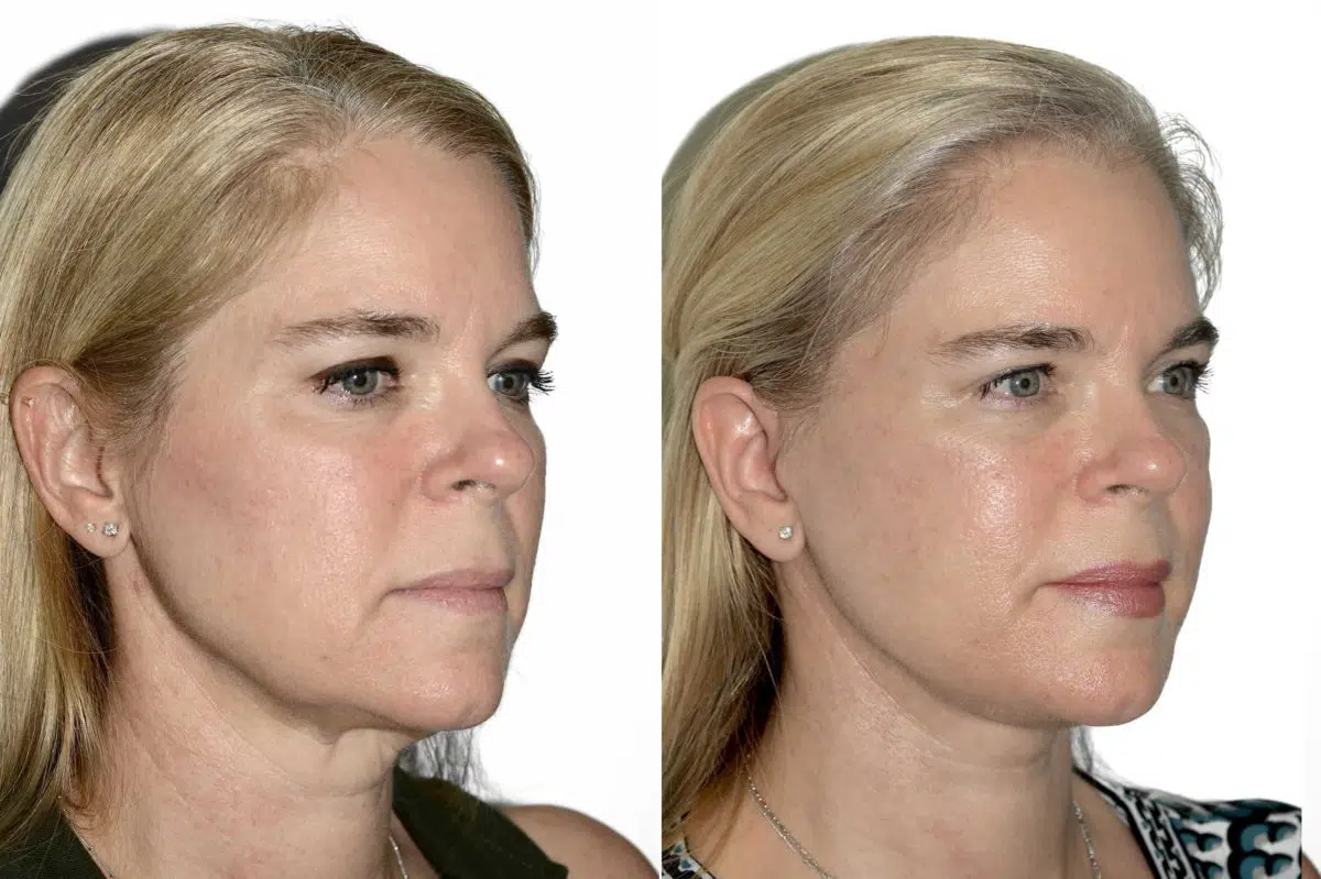 Deep Plane Facelift Before and After Photos in Miami, FL, Patient 21785