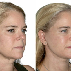 Deep Plane Facelift Before and After Photos in Miami, FL, Patient 21785