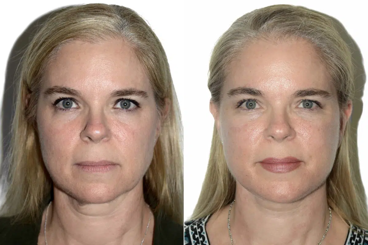 Deep Plane Facelift Before and After Photos in Miami, FL, Patient 21785