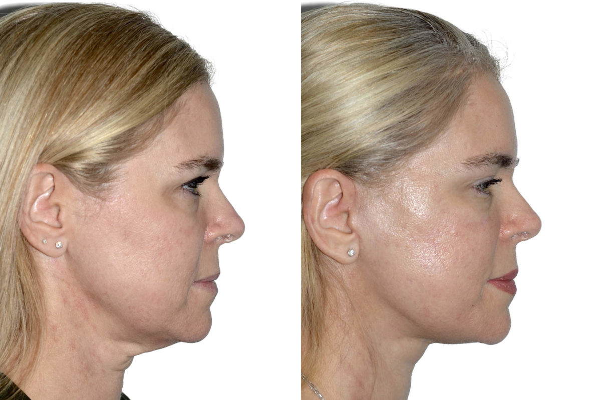 Deep Plane Facelift Before and After Photos in Miami, FL, Patient 21785