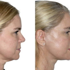 Deep Plane Facelift Before and After Photos in Miami, FL, Patient 21785