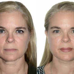 Deep Plane Facelift Before and After Photos in Miami, FL, Patient 21785