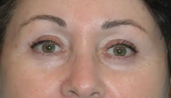 Post-operative view of the same patient after a browlift by Dr. Bustillo