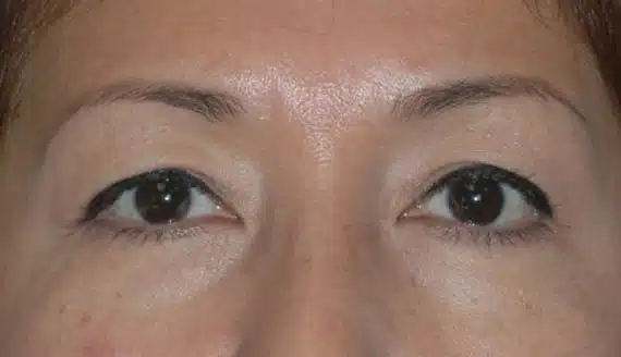 Female patient demonstrates aging upper eyelids with normal brow position