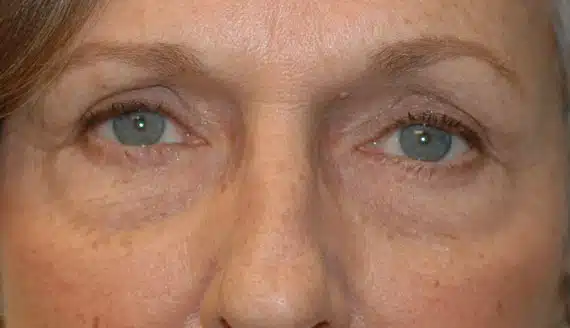 Female patient demonstrates aging lower eyelids with bags