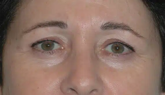 Female patient demonstrates aging eyebrows