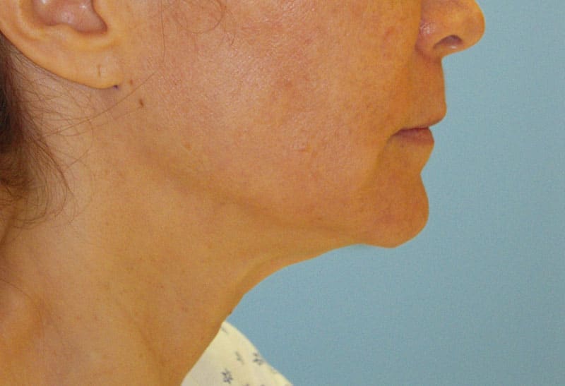 Neck Lift Photos in Miami