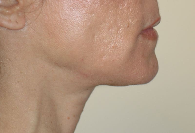 Neck Lift Photos in Miami