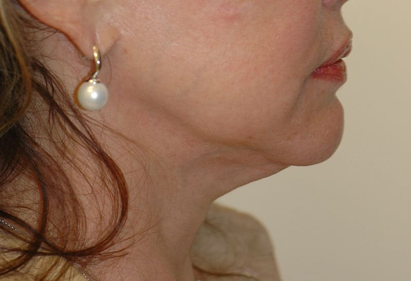 Neck Lift Photos in Miami