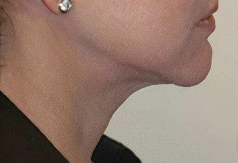 Neck Lift Photos in Miami