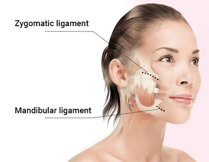 Diagram demonstrating the repositioning and elevation of the muscles of the face during the facelift as performed by Dr. Bustillo.