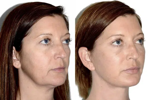 Deep Plane Facelift Before and After Photos in Miami, FL, Patient 22387