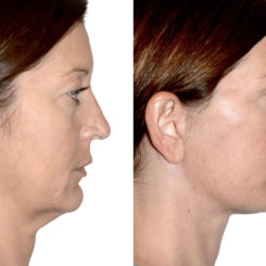 Deep Plane Facelift Before and After Photos in Miami, FL, Patient 22387