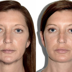 Deep Plane Facelift Before and After Photos in Miami, FL, Patient 22387
