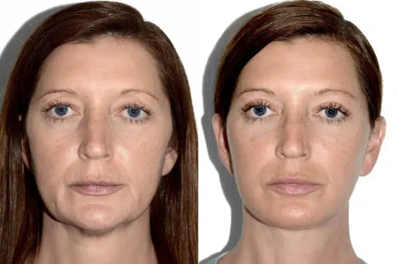 Deep Plane Facelift Before and After Photos in Miami, FL, Patient 22387