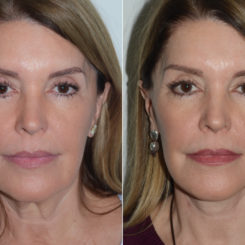 Deep Plane Facelift Before and After Photos in Miami, FL, Patient 19635